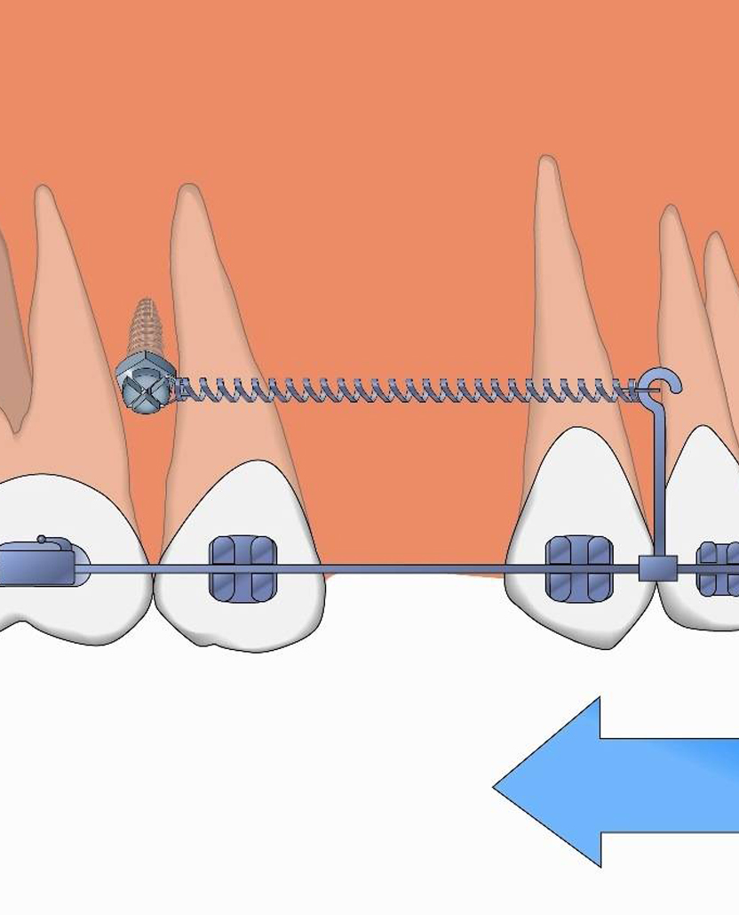Микроимпланты в Dentalika